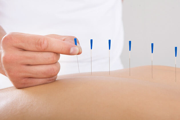 Acupuncture - popular traditional Chinese Medicine